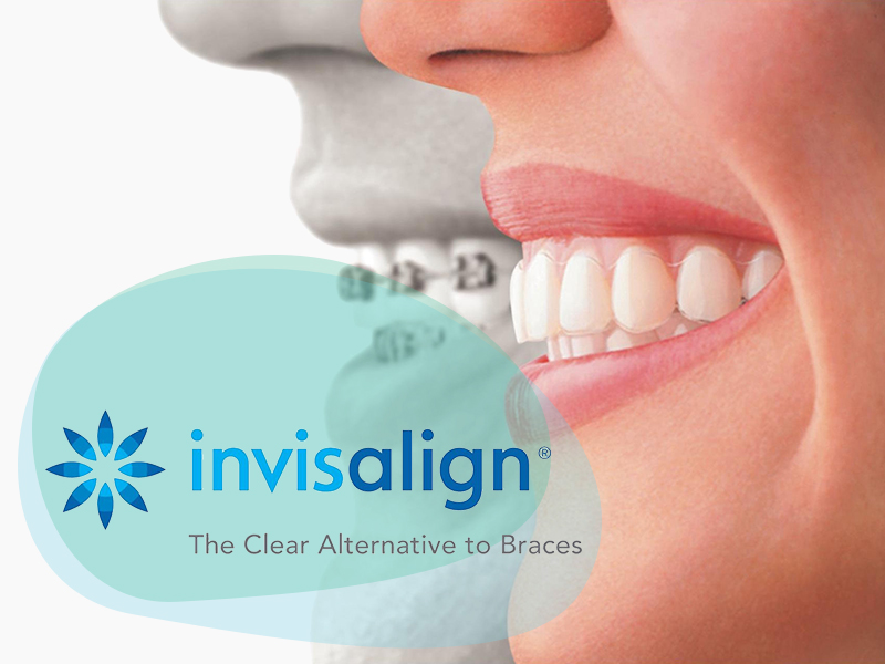 INVISALIGN